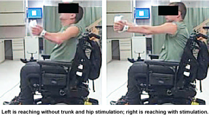 Demonstration of balance control with implanted neuroprosthesis